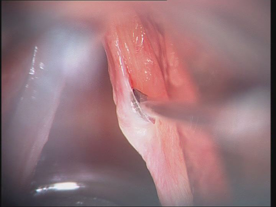 Fotos clínicas: Microcirugía endolaríngea. Incisión cordotomía