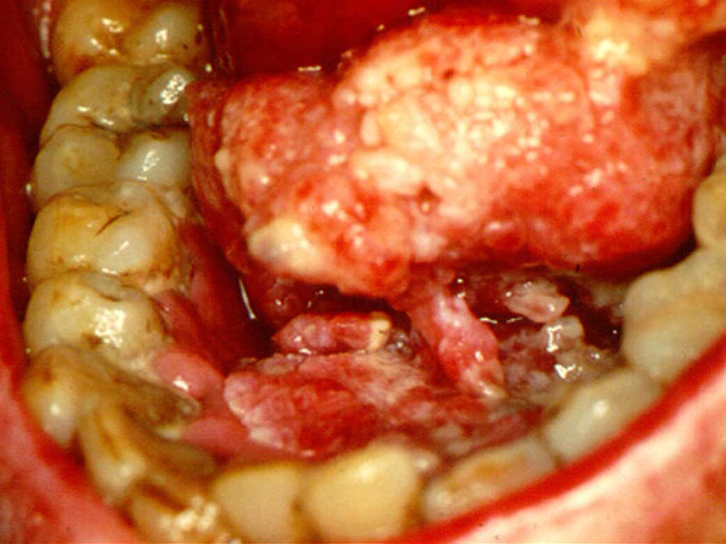 Fotos clínicas: Carcinoma de suelo de boca y lengua